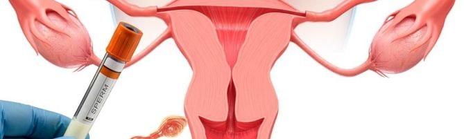 İntrauterin İnseminasyon (IUI) (Aşılama)